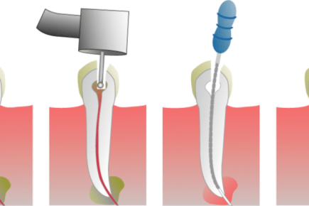 Root Canal